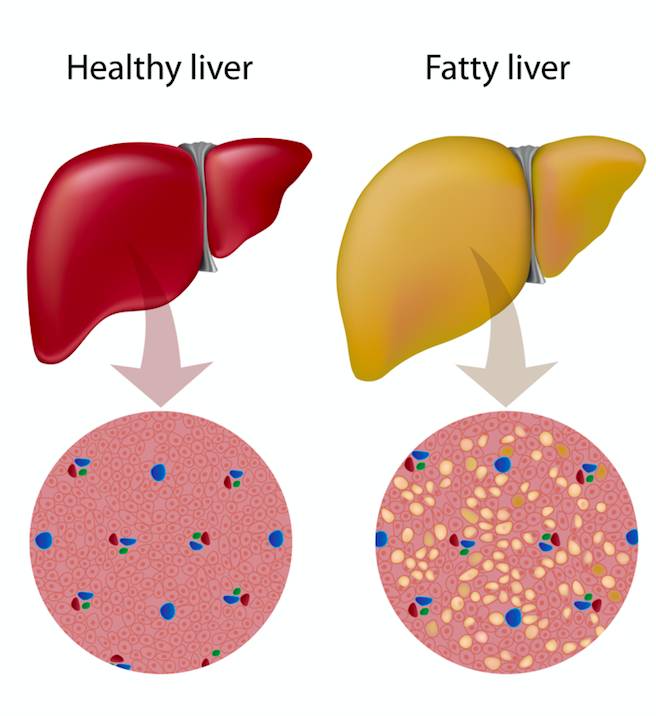 fatty liver